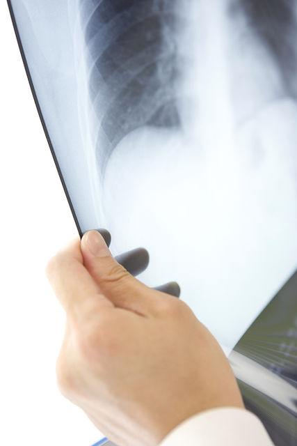 Hand holding a chest x-ray film — Diagnostic Imaging